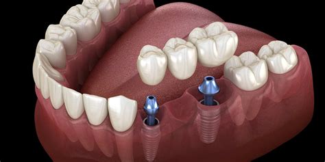 Dental Bridges vs. Dental Implants