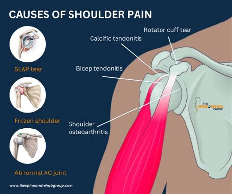 How to Resolve Right Neck and Shoulder Pain | The Spine & Rehab Group