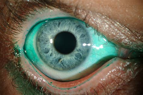 Atlas Entry - Lissamine green staining in keratoconjunctivitis sicca