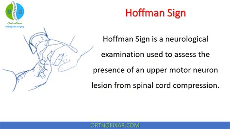 Hoffman Sign | Motor neuron, Neurons, Hoffman