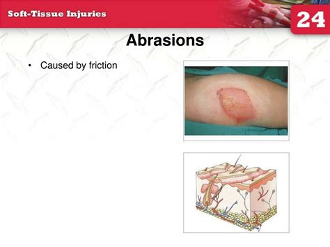 Abrasion Wound Diagram