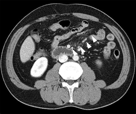 Abdominal CT findings. Abdominal CT scan revealed haziness in the ...