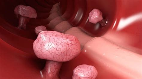 Cold Snare Polypectomy Tops Hot Snare For Small Polyps