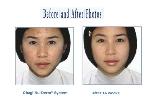 Obagi before and after photos