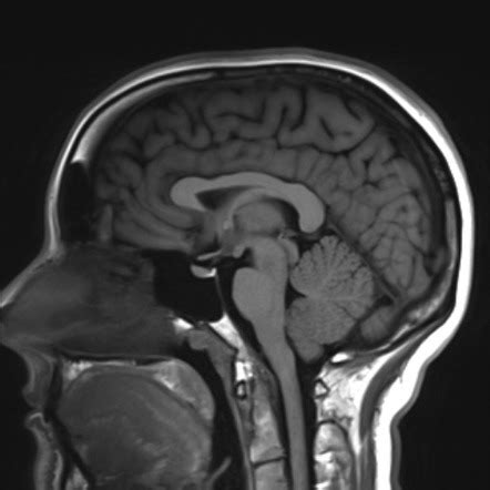 Mri Images Of The Brain