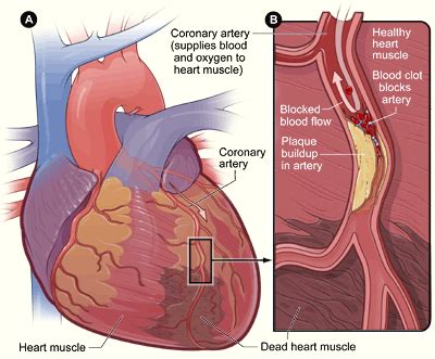 Heart Attacks: Levels & Types - Phlebotomy Career Training