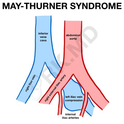 May-Thurner Syndrome | RK.MD