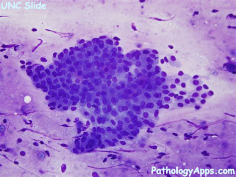 warthin tumor salivary gland cytology