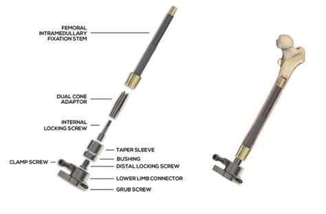 Benefits of osseointegration over socket implants for amputees