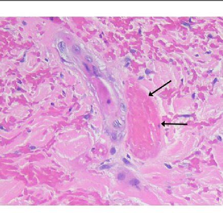 Histopathology of livedoid vasculopathy skin lesions. Left: Livedoid ...