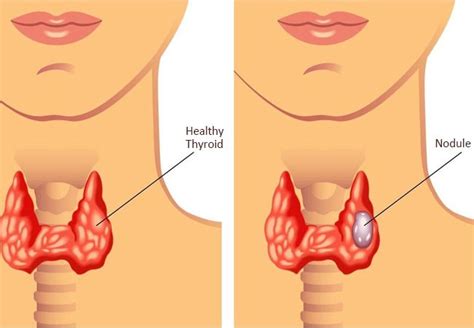 Thyroid Nodules: Symptoms and Treatment at Silverline Kochi