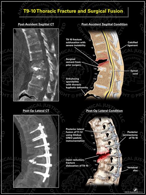 T9-10 Thoracic Fracture and Surgical Fusion