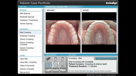 Invisalign Mild Crowding - YouTube