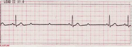 Second Degree Heart Block Type II ECG Interpretation #316