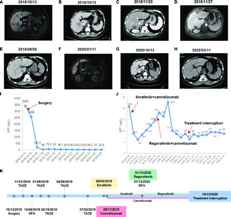 Changes in imaging and serum AFP level during clinical treatment. (A ...