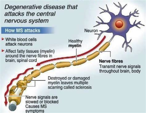 Multiple Sclerosis and Exercise - Pivotal Physio