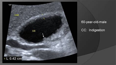 Adenomyomatosis of gallbladder - YouTube