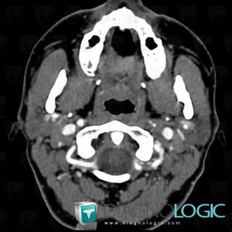 Radiology case : Arterial dissection (CT ,MRI) - Diagnologic