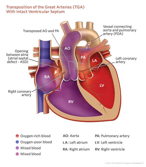 About Transposition of the Great Arteries in 2023 | Pediatric nursing ...