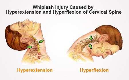 Whiplash Injury | Med-Health.net