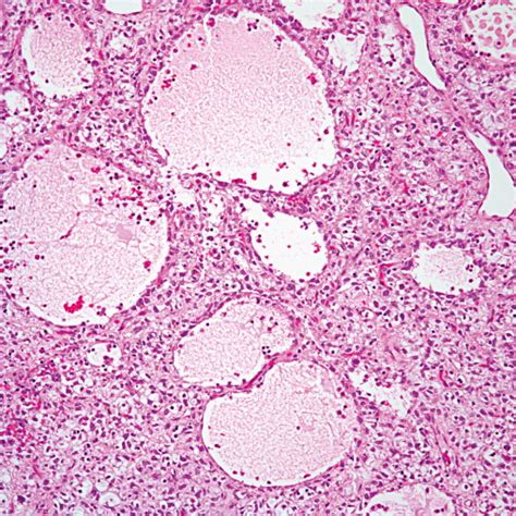 Benign Tumors and Tumor-like Lesions of the Lung | Thoracic Key