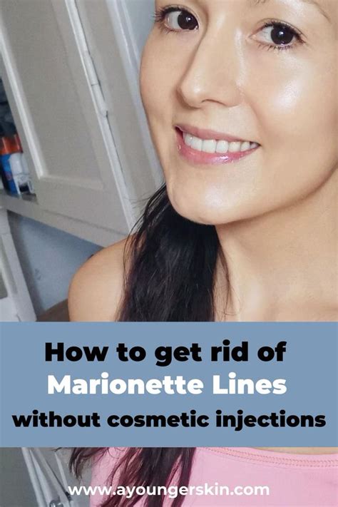 Jowls and Marionette lines treatment [how to get rid of marionette lines naturally] - A younger skin