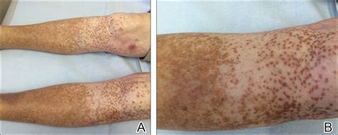 Granulomatous Pigmented Purpuric Dermatosis | MDedge Dermatology