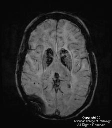 Neuroradiology On the Net: Mineralizing microangiopathy