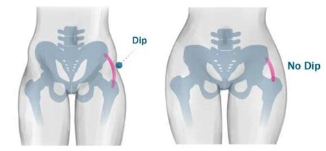 Hip Dips and How MediCramp Muscle Relief Meds Enhance Exercise Effectiveness