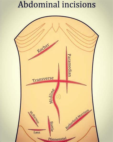 Abdominal Incisions in GENERAL SURGER | Surgical technologist student, Surgical nursing, Medical ...