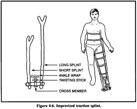 How to Set a Broken Bone in an Emergency / The ReadyBlog