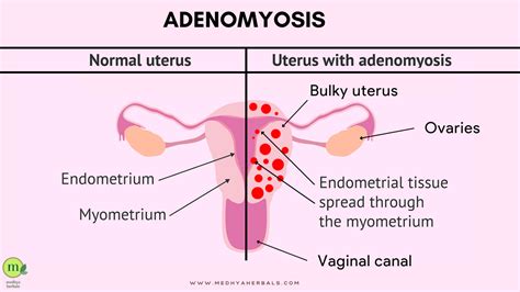 Adenomyosis Vs Endometriosis: What You Need to Know