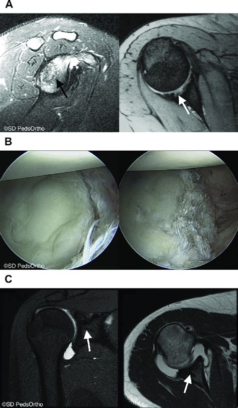 OCD of the glenoid fossa in a 15-year-old softball player with... | Download Scientific Diagram