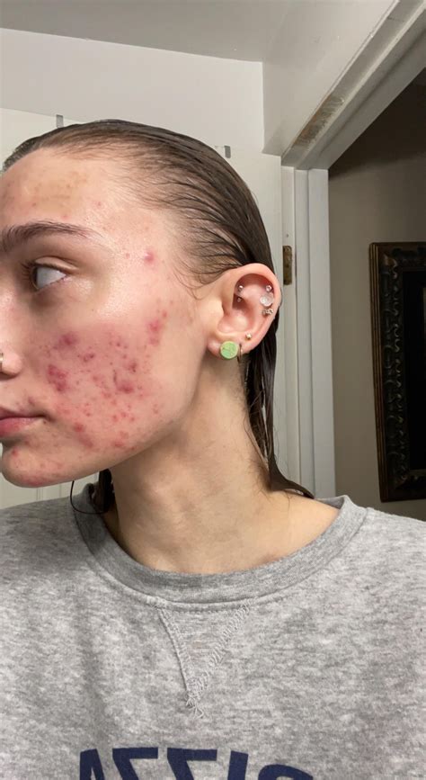 Before and After being prescribed Clindamycin : r/acne