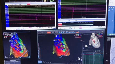 Cardiac ablation surgery: Types, risks, what to expect, and more