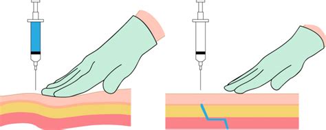 18.6 Administering Intramuscular Medications – Nursing Skills – 2e