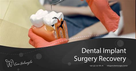 Dental Implant Surgery Recovery - Dental Implant Surgery Recovery Time