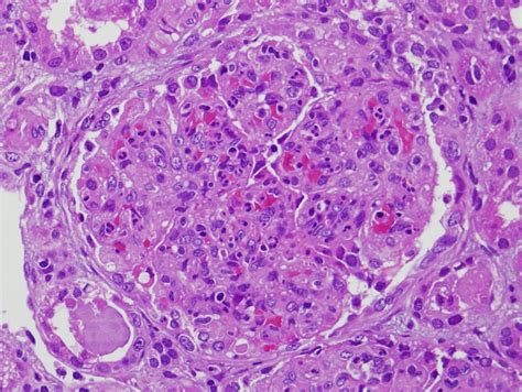 Renal Pathology Review: Post-streptococcal glomerulonephritis and chronic kidney disease (CKD)