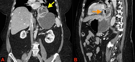 An Unusual Case of an Acute Mesenteroaxial Gastric Volvulus Secondary to a Hiatal Hernia | Cureus