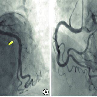 Coronary angiography images. (A) Coronary angiography showed the ...