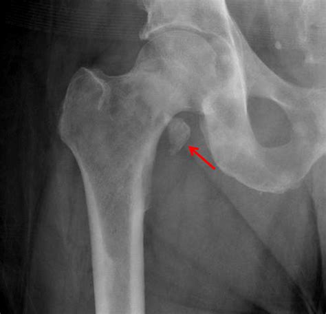 Lesser Trochanter Avulsion Fracture Therapy – FRACTURE