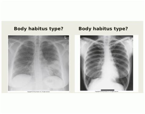 Body Habitus Types — Quiz Statistics