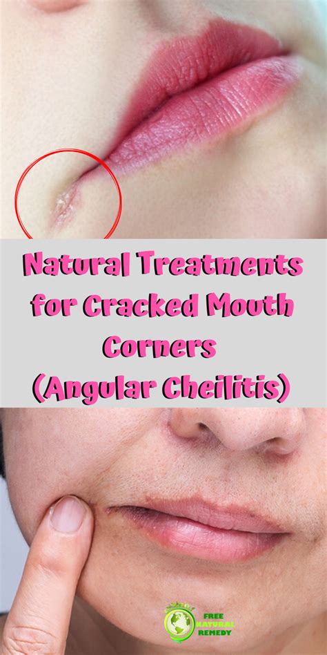 Causes And Remedies For Angular Cheilitis (Cracked Lip Corners | Cracked corners of mouth ...