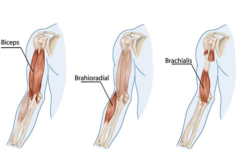 Distal Biceps Tendonitis