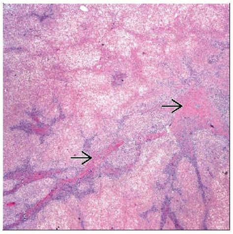 Focal Nodular Hyperplasia Basicmedical Key | Hot Sex Picture