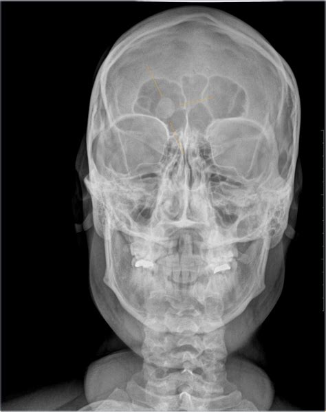 Frontal Osteoma: Xray - Sumer's Radiology Blog