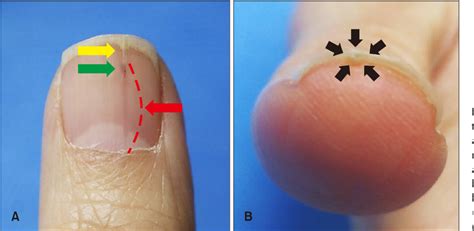 [PDF] A Rare Case of Onychopapilloma Presenting as a Longitudinal ...