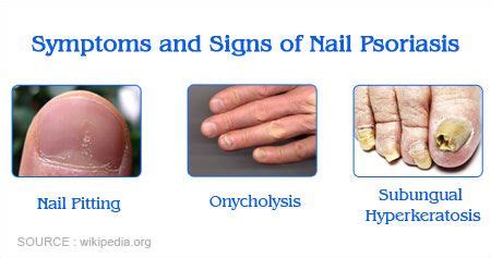 Nail Psoriasis - Causes, Symptoms, Diagnosis, Treatment & Prevention ...