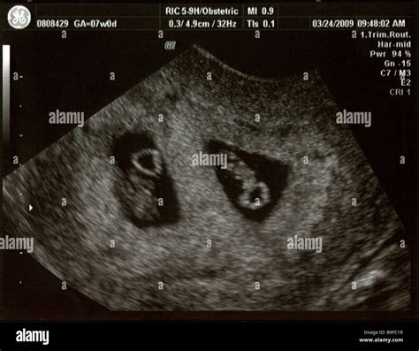 Ultrasound showing foetal development of fraternal twins at 7 weeks, conceived through IVF Stock ...