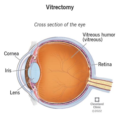 Vitrectomy: Definition, Details & Recovery